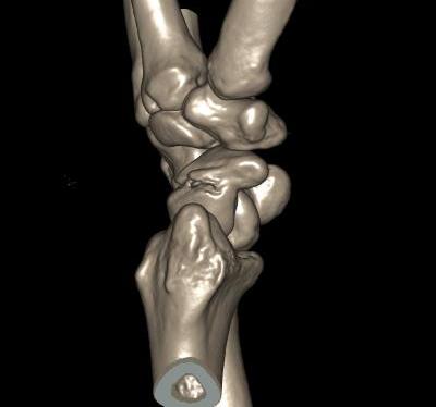 Scaphoid Fracture 3D CT